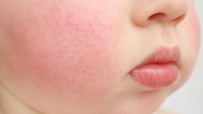 3 Faktor Umum Penyebab Kulit Alergi Pada Kulit Si Kecil